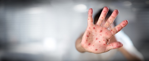 Experts alarm health alert as measles reapproaches the US after the number of unvaccinated people traveling abroad rises.